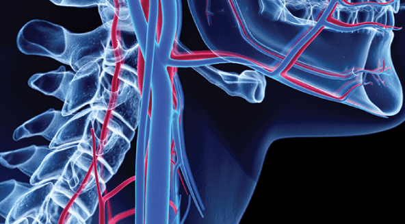 Carotid Artery Occlusion Can Cause Paralysis