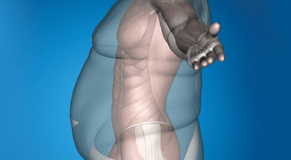 Rebirth with Obesity Surgery