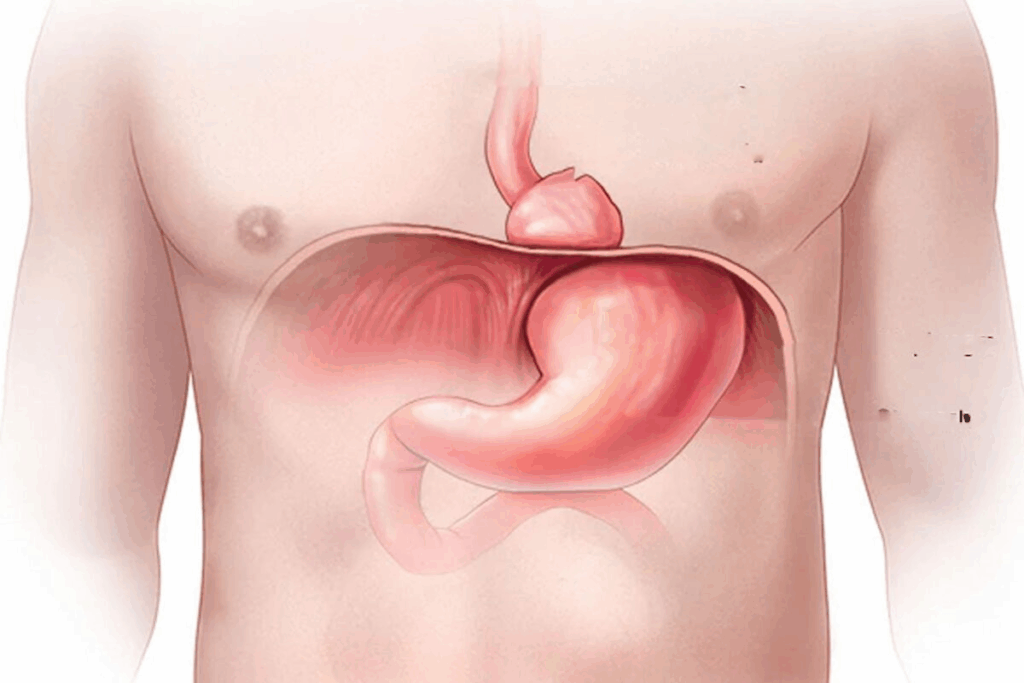 Understanding Schotskys Ring (Schatzki Ring)