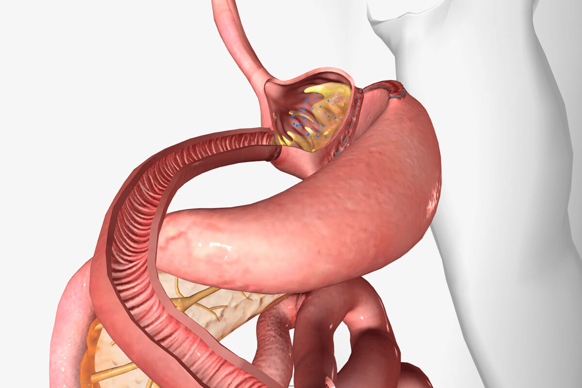 Management Of Post Gastric Bypass Constipation