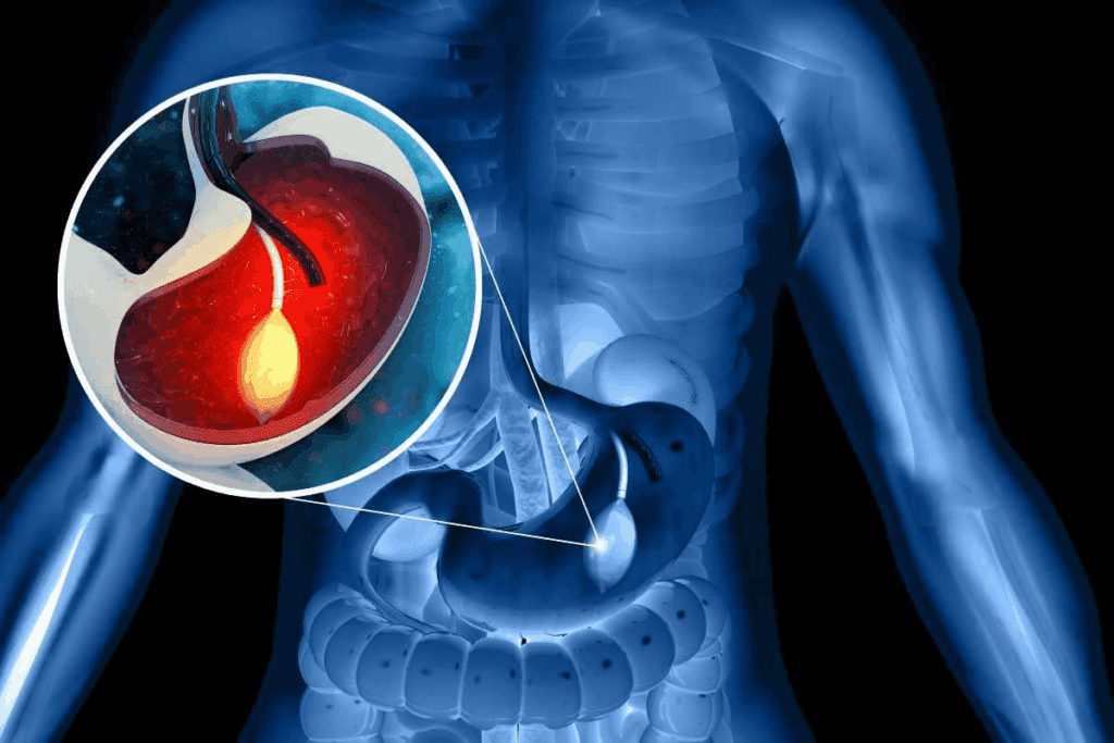 Comparing Endoscopic Sleeve Vs Gastric Sleeve (Esg Vs. Vsg)
