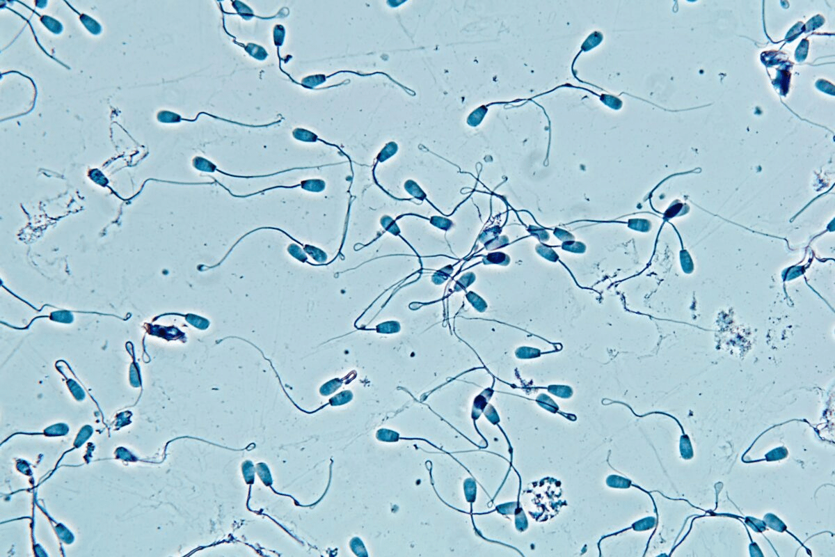 Causes of absence of sperm in the semen (Obstructive/Non-Obstructive)