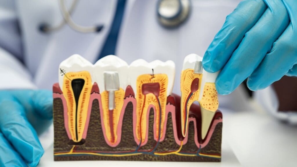 dental bone loss