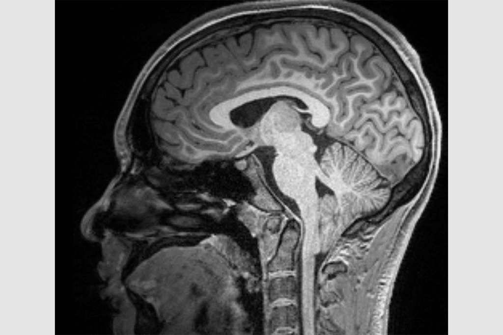 Chiari Malformation: 5 Key Facts About the Most Common Type Clearly Explained for Better Hope 1 Chiari Malformation: 5 Key Facts About the Most Common Type Clearly Explained for Better Hope