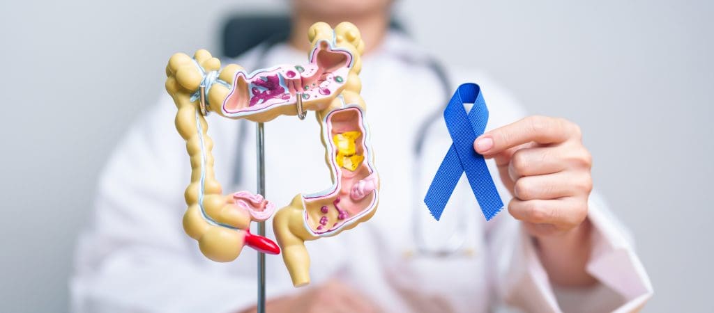 What is Stage 0 Colon Cancer