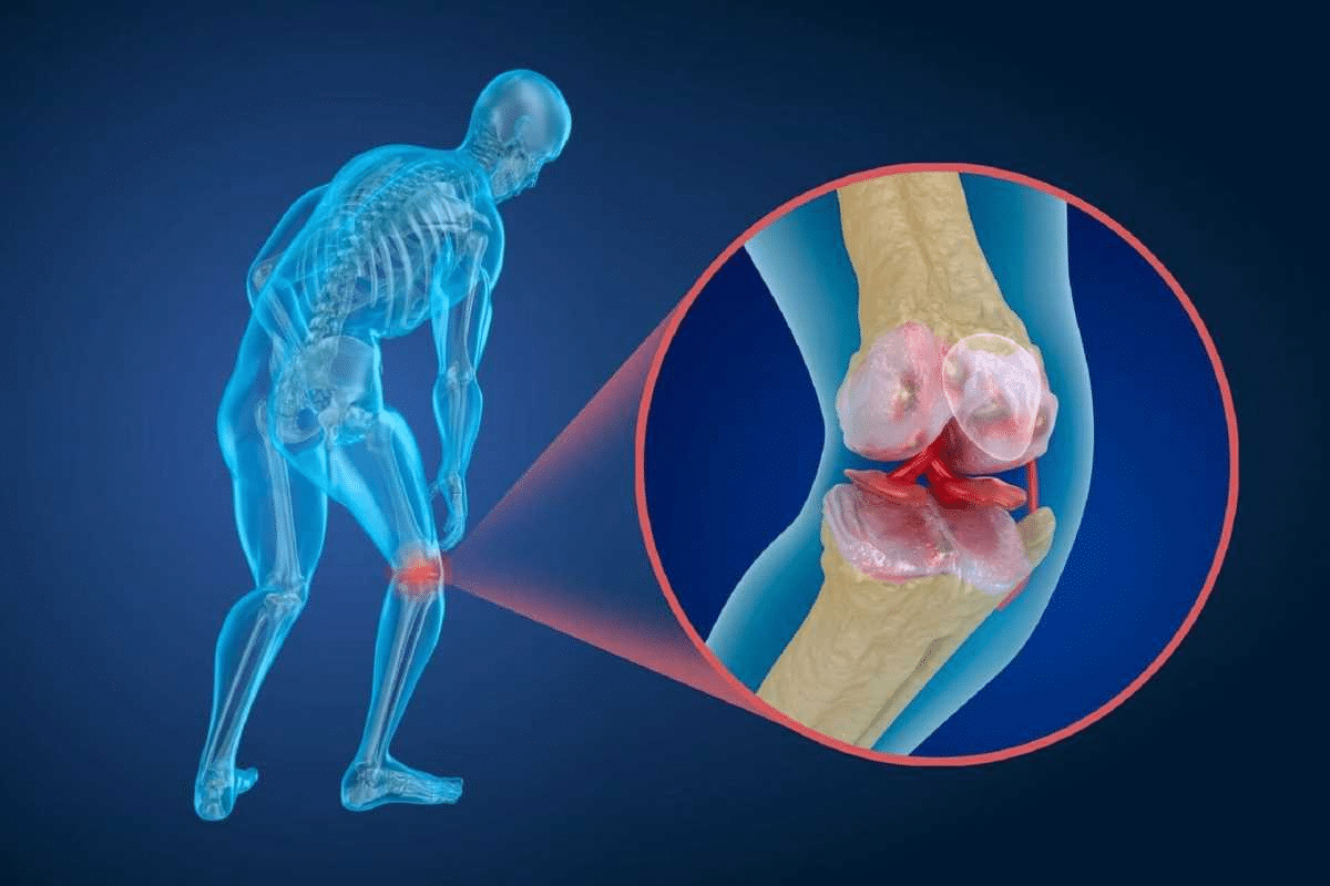 Disease Where Bones Break Easily: Guide