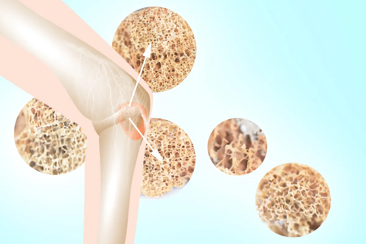 What Causes Brittle Bones Disease? Info