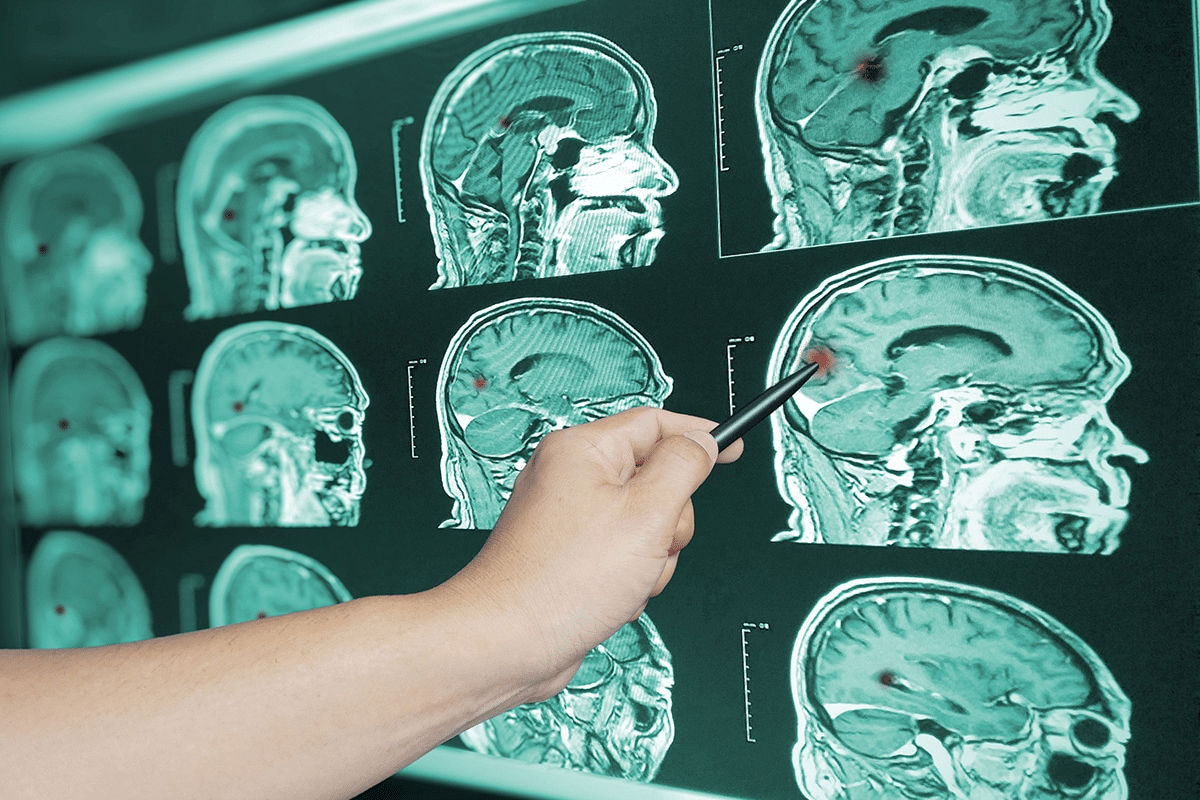 Brain Damaged People: Best Care Tips