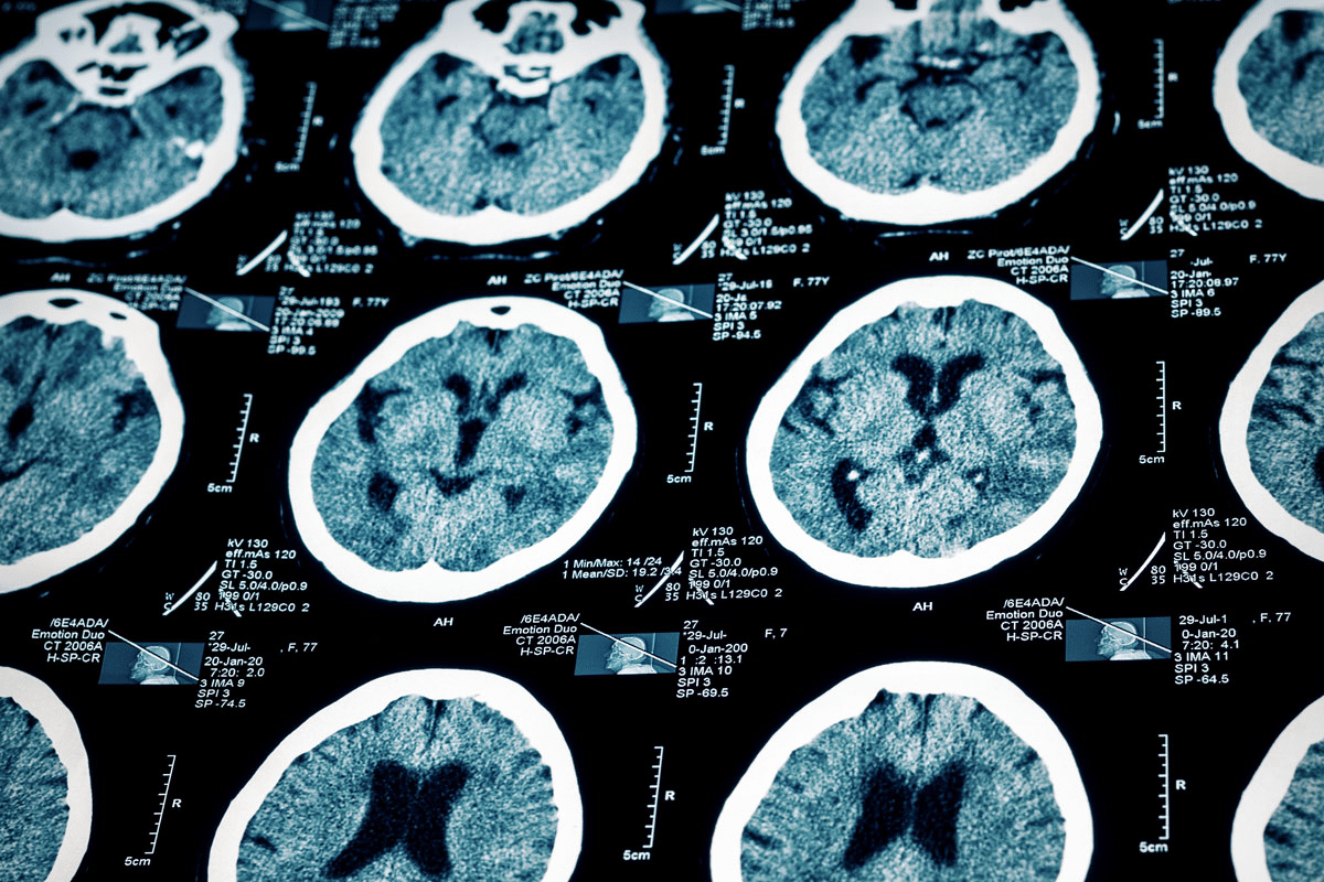 What Causes Brain Injury? Best Guide