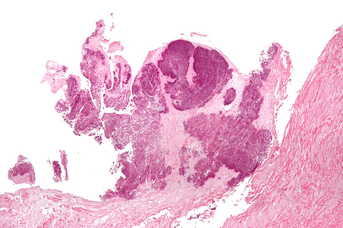 Profound Guide To Calcium Crystal Disease (CPPD Arthritis)