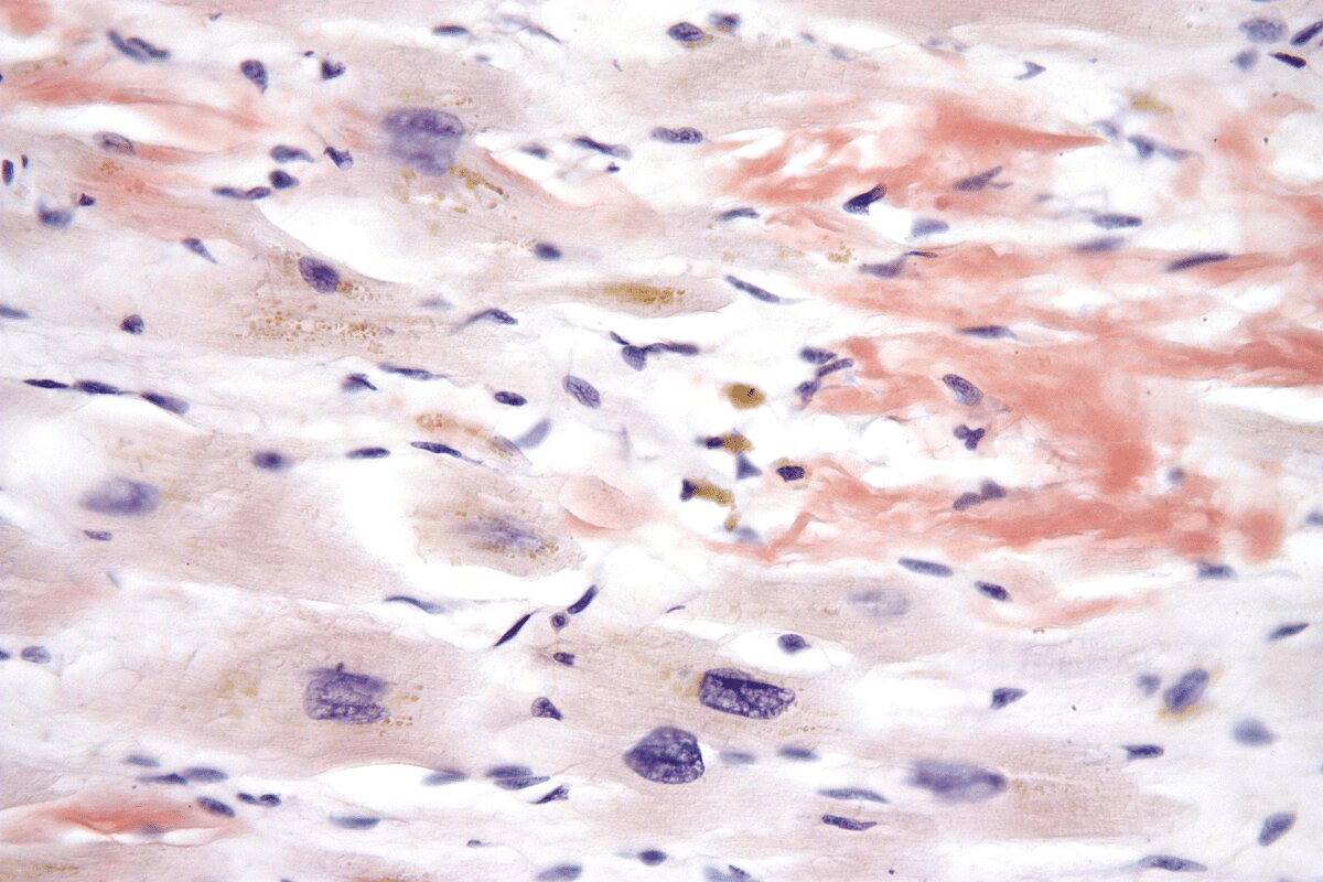 Kappa Light Chain Amyloidosis: Essential Facts