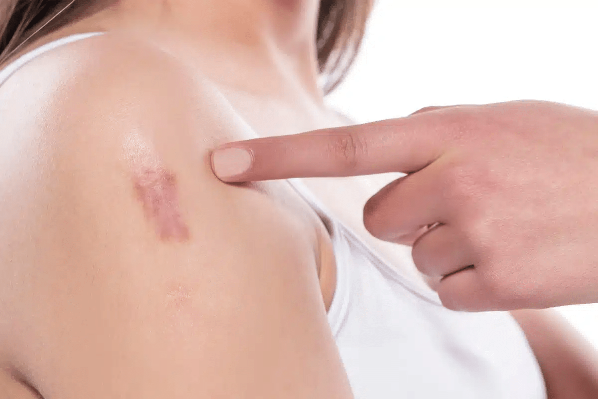 Complete 5 Key Signs Of Mild Cutaneous Vasculitis