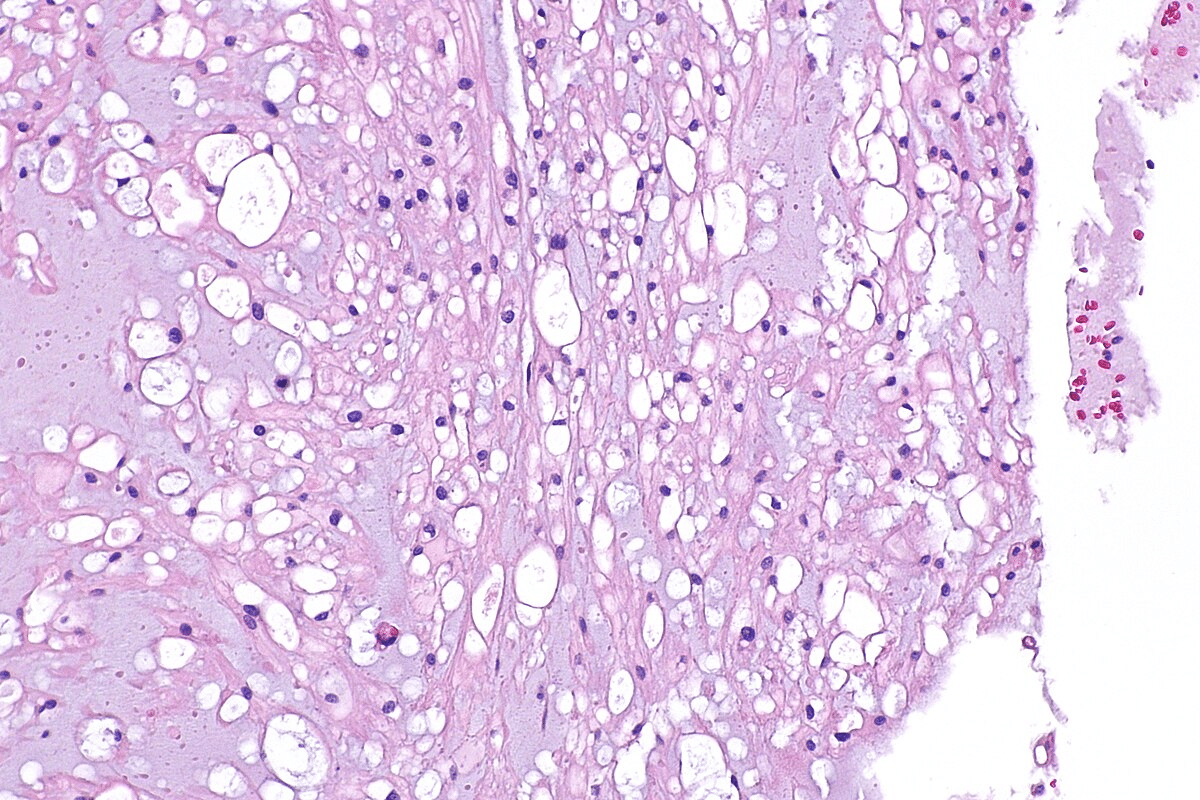 Key Complete Guide To Skin Lupus Treatment 3 Key Complete Guide To Skin Lupus Treatment