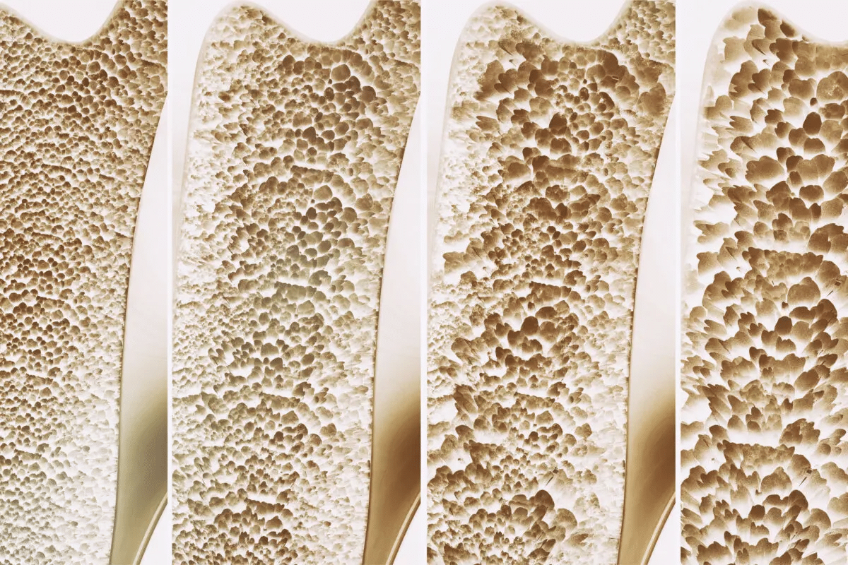 Valuable What Osteoporosis Labs Diagnose The Disease?