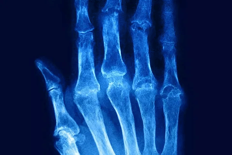 Guide Can Rheumatoid Arthritis Cause Muscle Pain & Aches?