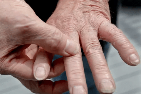 Profound 7 Best Alternative Therapies For Rheumatoid Arthritis 3 Profound 7 Best Alternative Therapies For Rheumatoid Arthritis