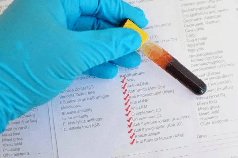 Simple What Is An ANA Blood Test: Results Explained 2 Simple What Is An ANA Blood Test: Results Explained