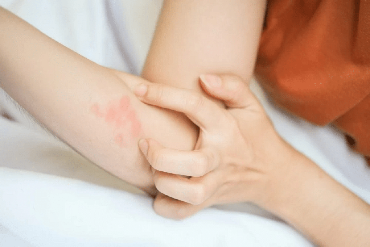 Amazing Autoimmune Rash On Arms: Which Diseases?