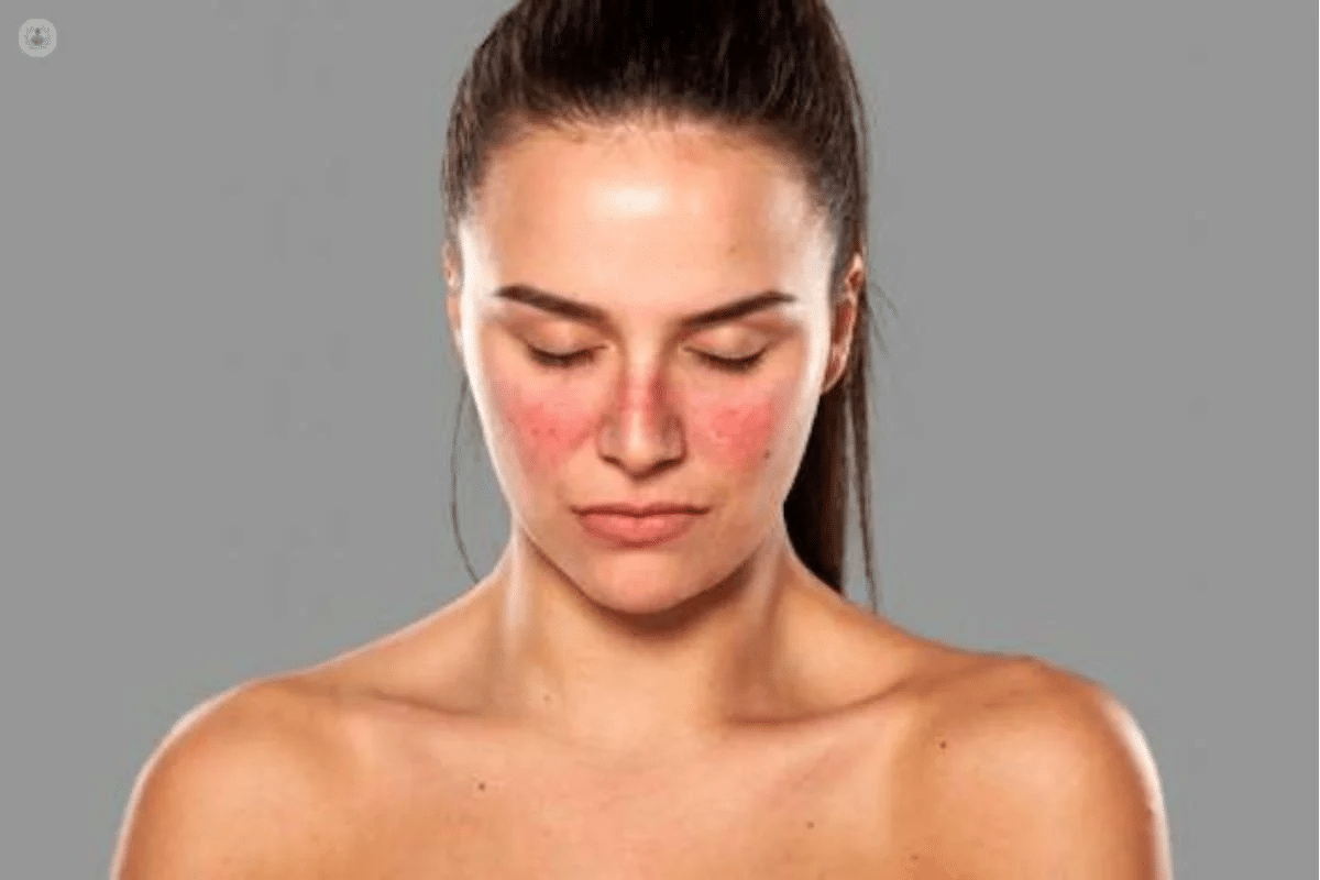 Essential Is Lupus Hereditary: Genetic Risk & Factors 3 Essential Is Lupus Hereditary: Genetic Risk & Factors