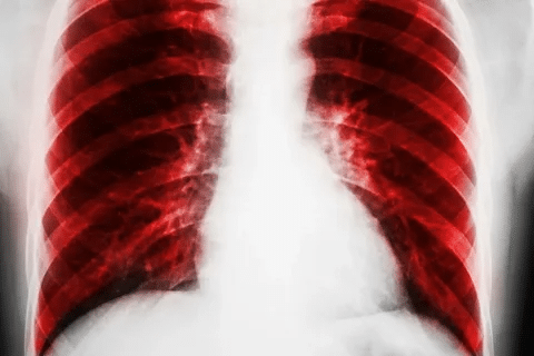 Key How Many Types Of Pneumonia Are There? Explained 2 word image 240256 2 LIV Hospital
