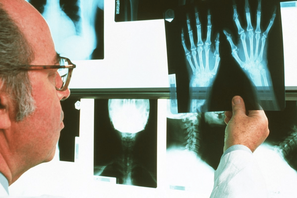 Profound Autoimmune Disease That Causes Hives & Treatment