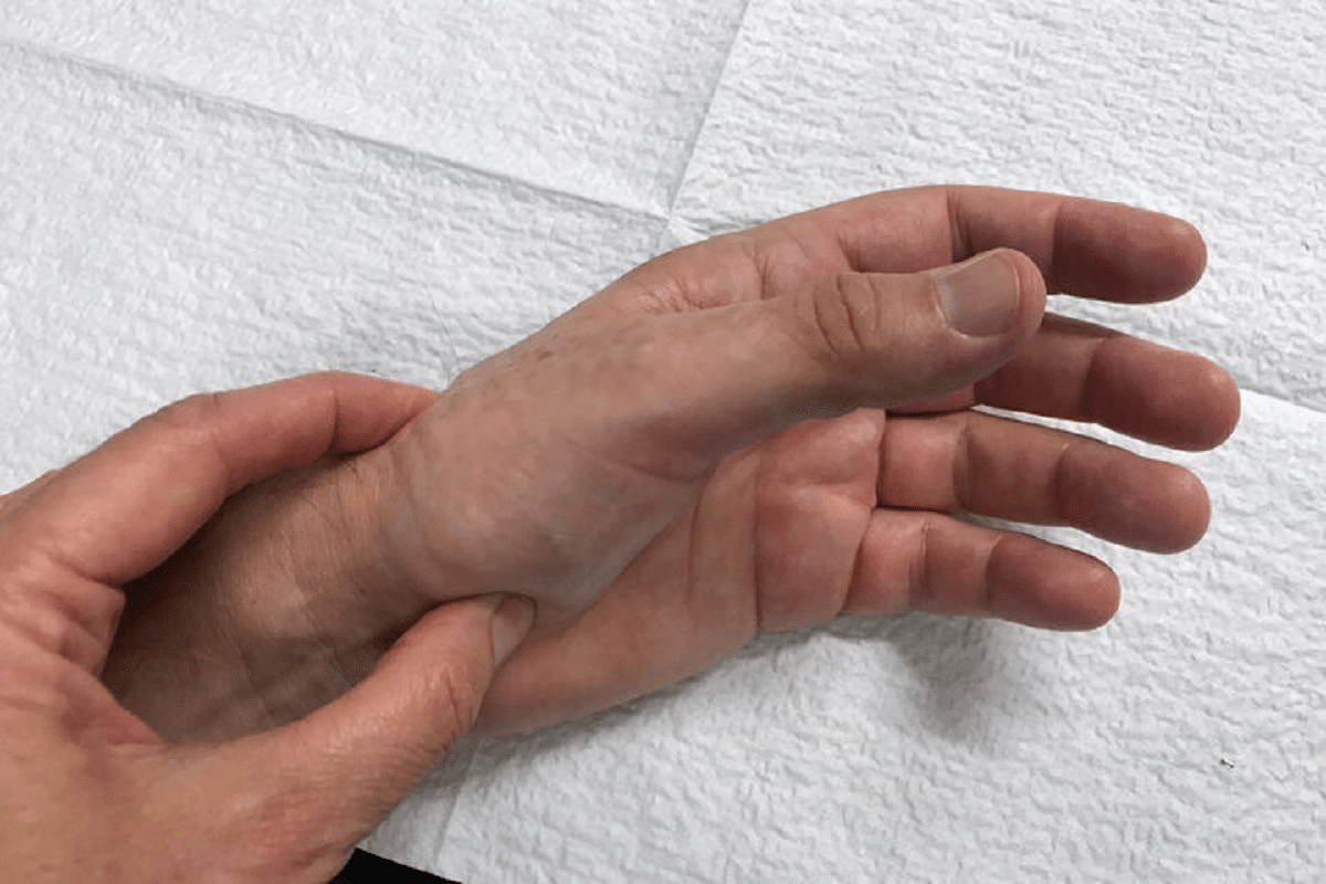 Key Therapy For Thumb Arthritis: Step-by-Step Exercises 2 Key Therapy For Thumb Arthritis: Step-by-Step Exercises