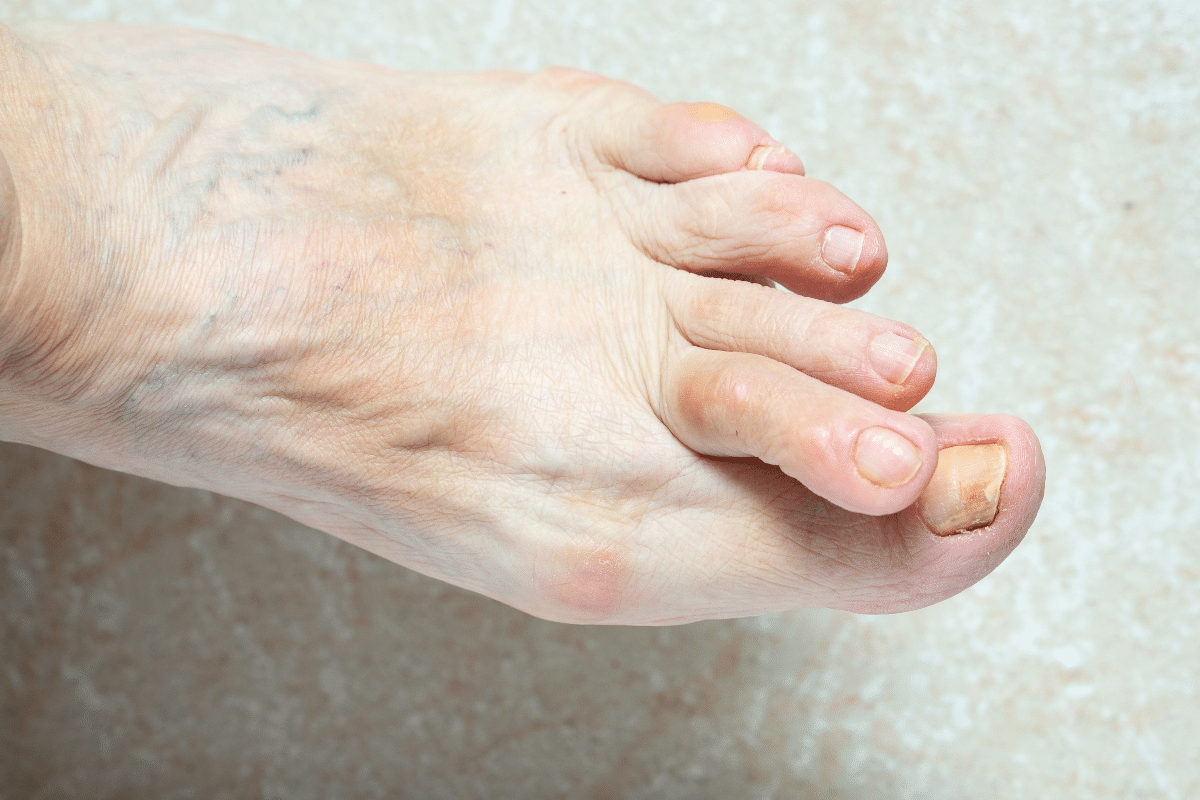 Profound Complete Guide To Treat Arthritis In Feet