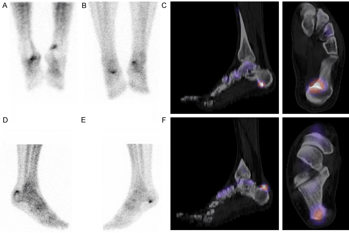 Amazing Treatment Of ANCA Vasculitis: Clinical Guide