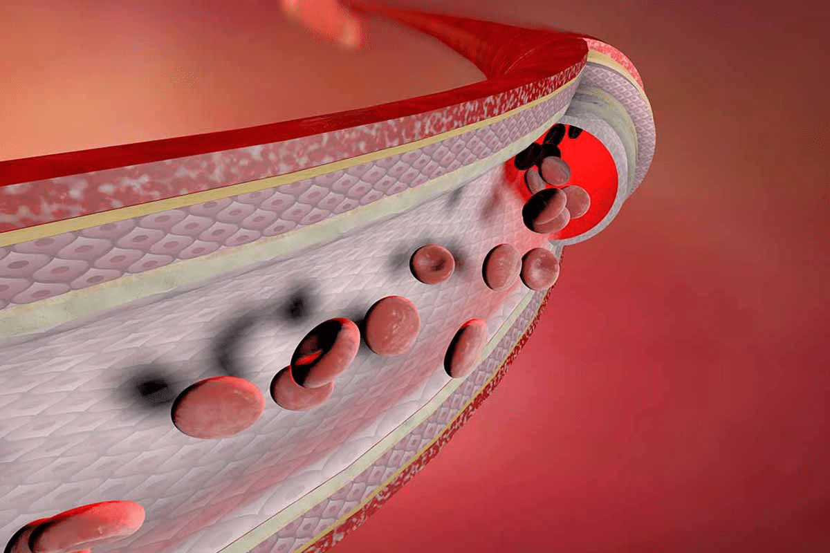 Profound C ANCA Positive Vasculitis: Diagnosis & Causes