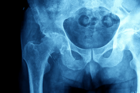 Complete Positive P ANCA And C ANCA Test Meaning