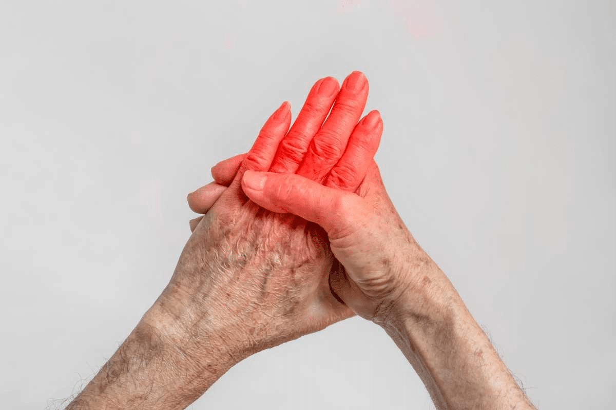 Fascinating Rheumatoid Arthritis Flare Up: Causes & Feel
