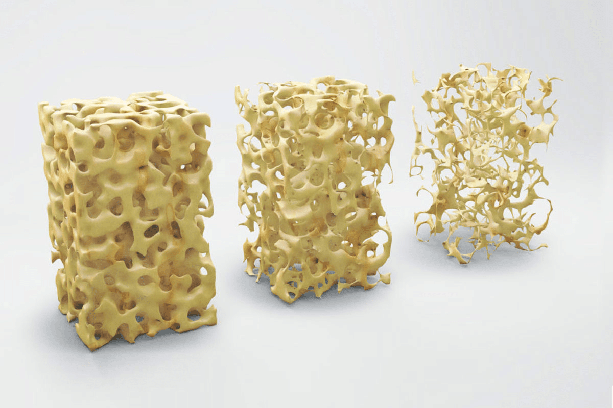 Essential 5 Natural Methods: Can Bone Loss Be Reversed?