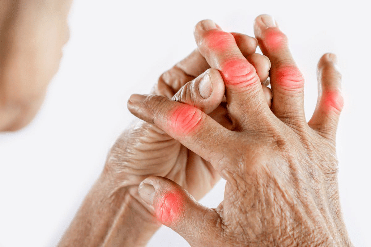 Complete 4 Stages Of Rheumatoid Arthritis Progression