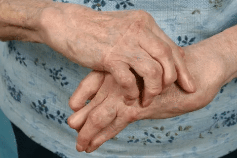 Complete 4 Stages Of Rheumatoid Arthritis Progression