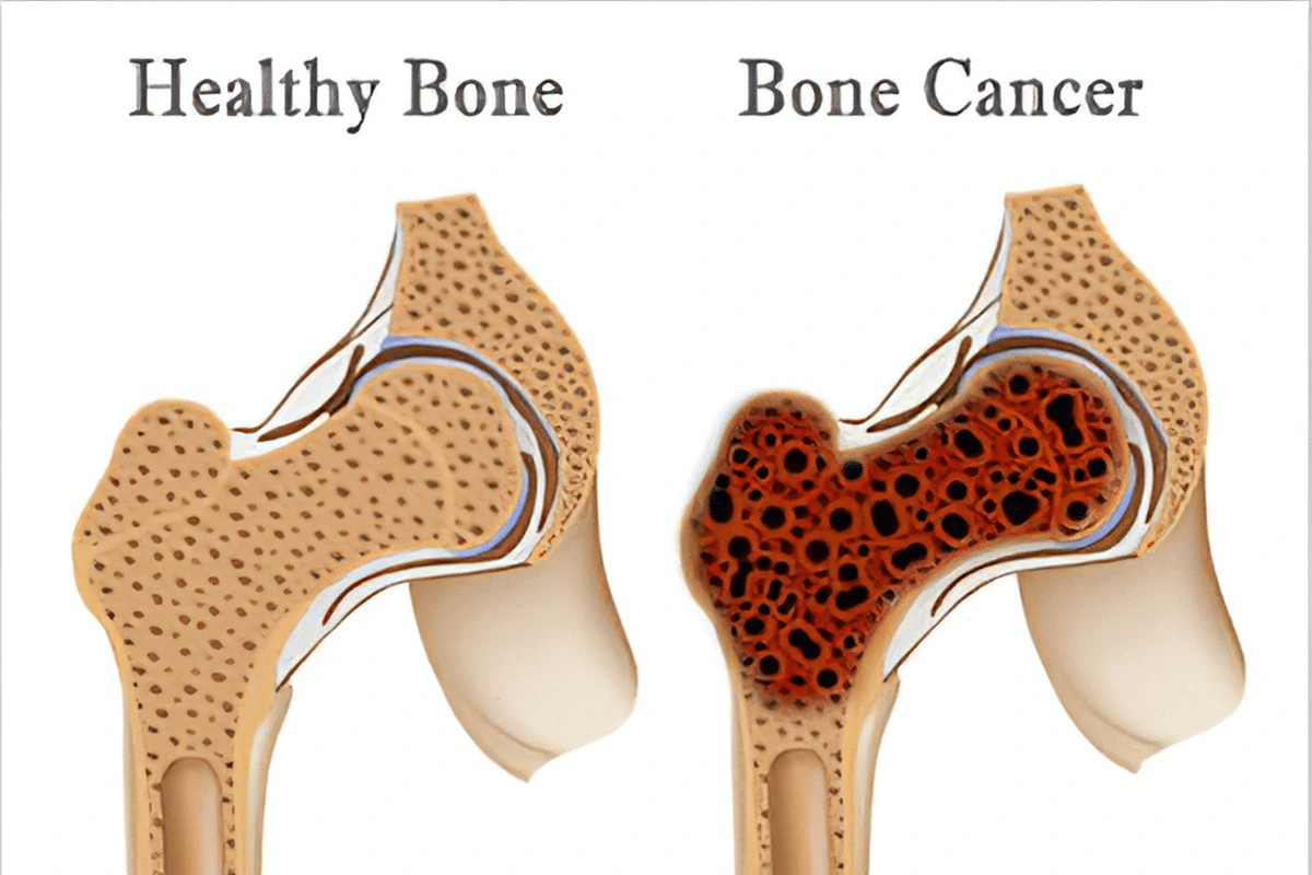 Fascinating What Does Bone Pain In Legs Feel Like? 2 Fascinating What Does Bone Pain In Legs Feel Like?