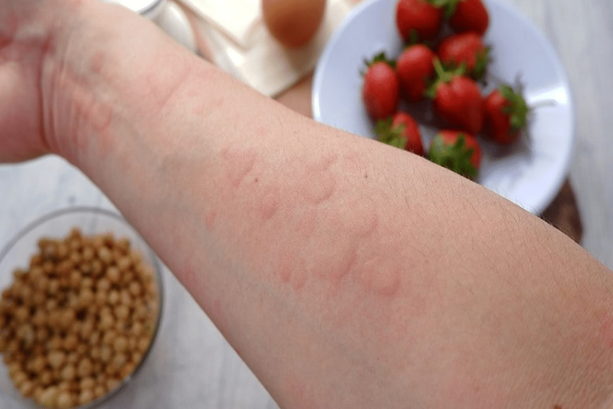 Can Allergies Give You Diarrhea? Vital Signs 2 Can Allergies Give You Diarrhea? Vital Signs