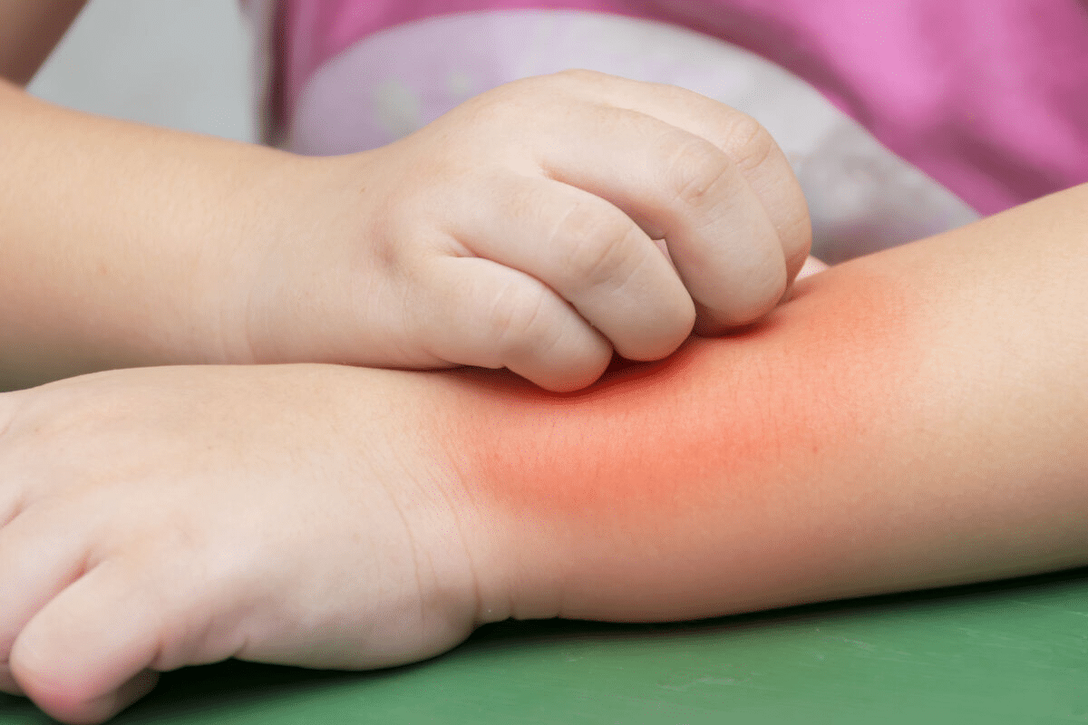 What Is Anaphylaxis? Urgent Danger Signs