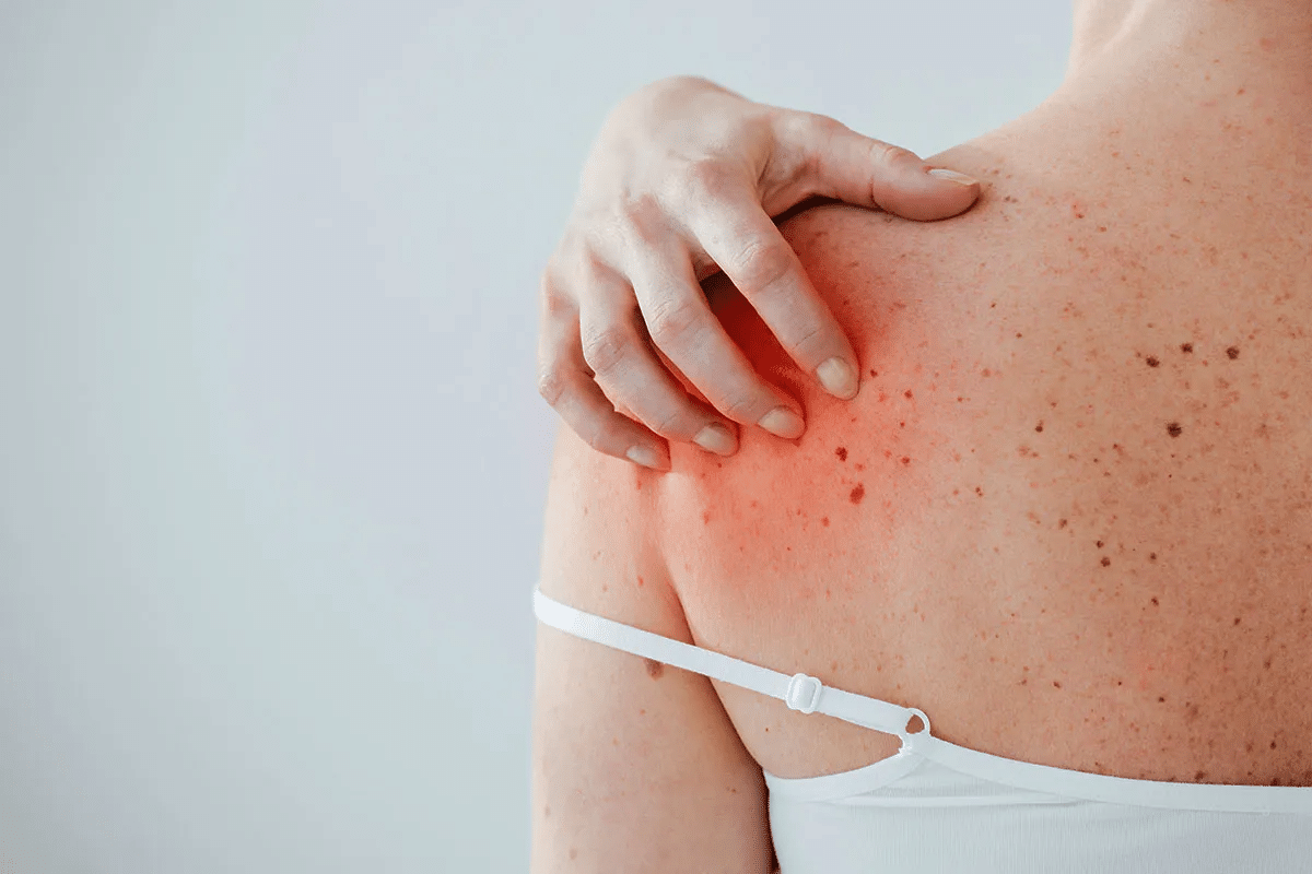 What Is Anaphylaxis? Urgent Danger Signs