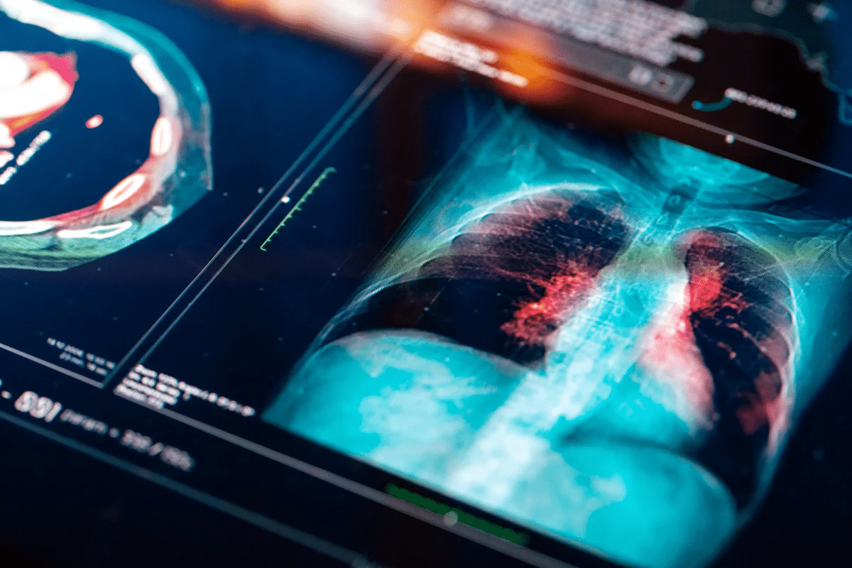 Insightful 7 Common Lung Abnormalities On Xray Guide