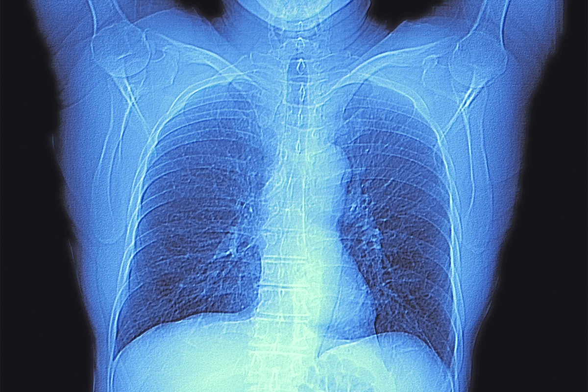 Ultimate 5 Abnormal Lung CT Scan Findings Guide