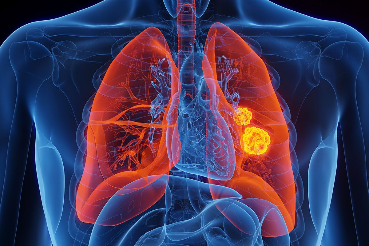 Ultimate 4 COPD Categories: GOLD Guide