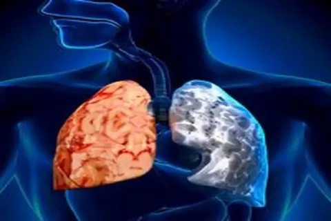 Ultimate 4 COPD Categories: GOLD Guide