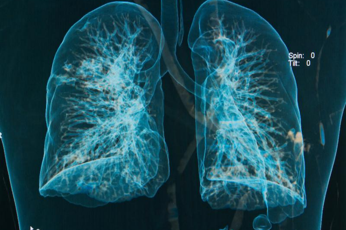 Average Lifespan of COPD Patient: Vital 2 Average Lifespan of COPD Patient: Vital