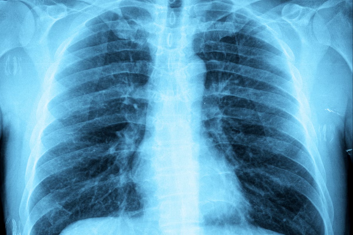 How Do You Get Bronchitis? Essential Facts