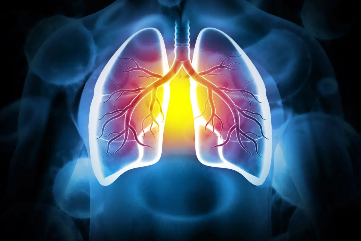 How Do You Get Bronchitis? Essential Facts