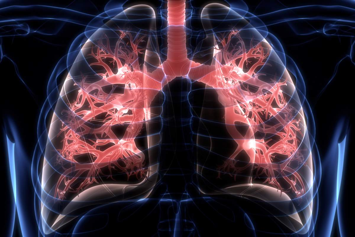 Amazing Can Xray Of Chest Infection Detect Pneumonia?