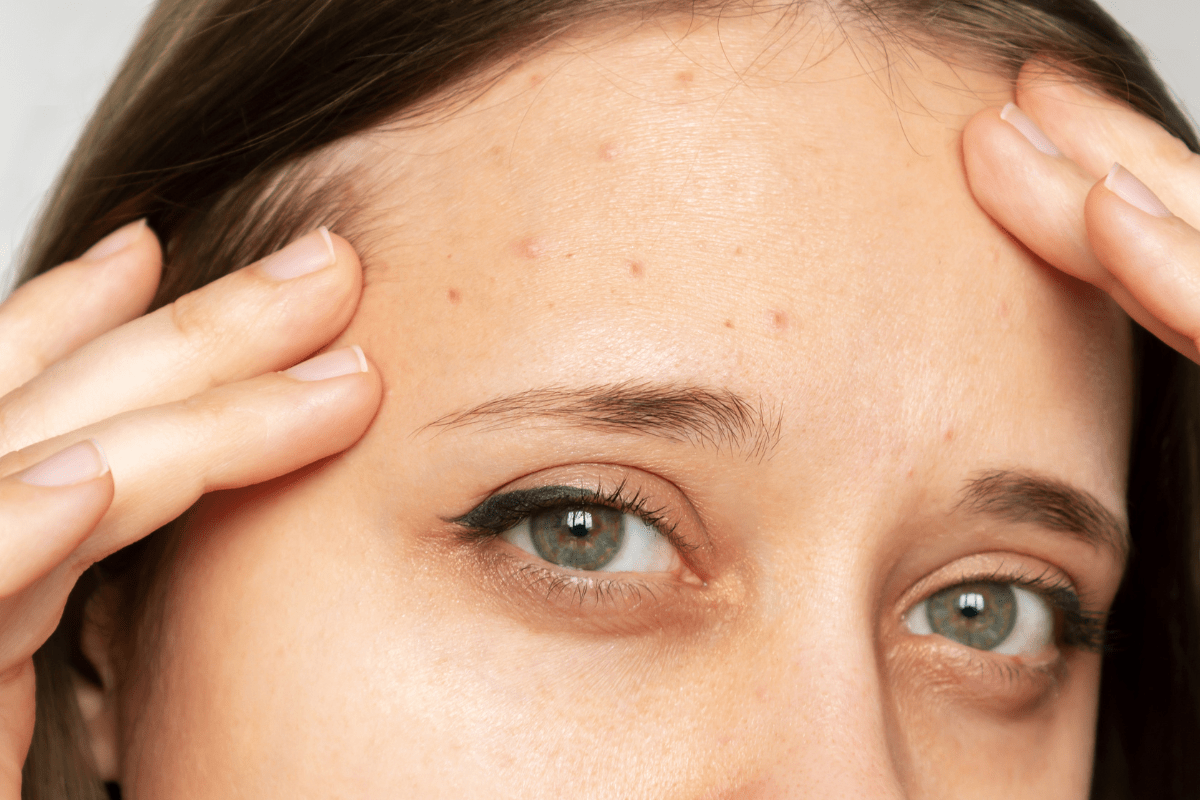 Hives on Face: Safe & Fast Relief Guide