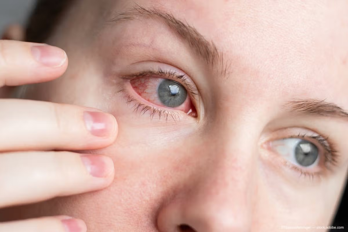 Allergic Conjunctivitis in One Eye