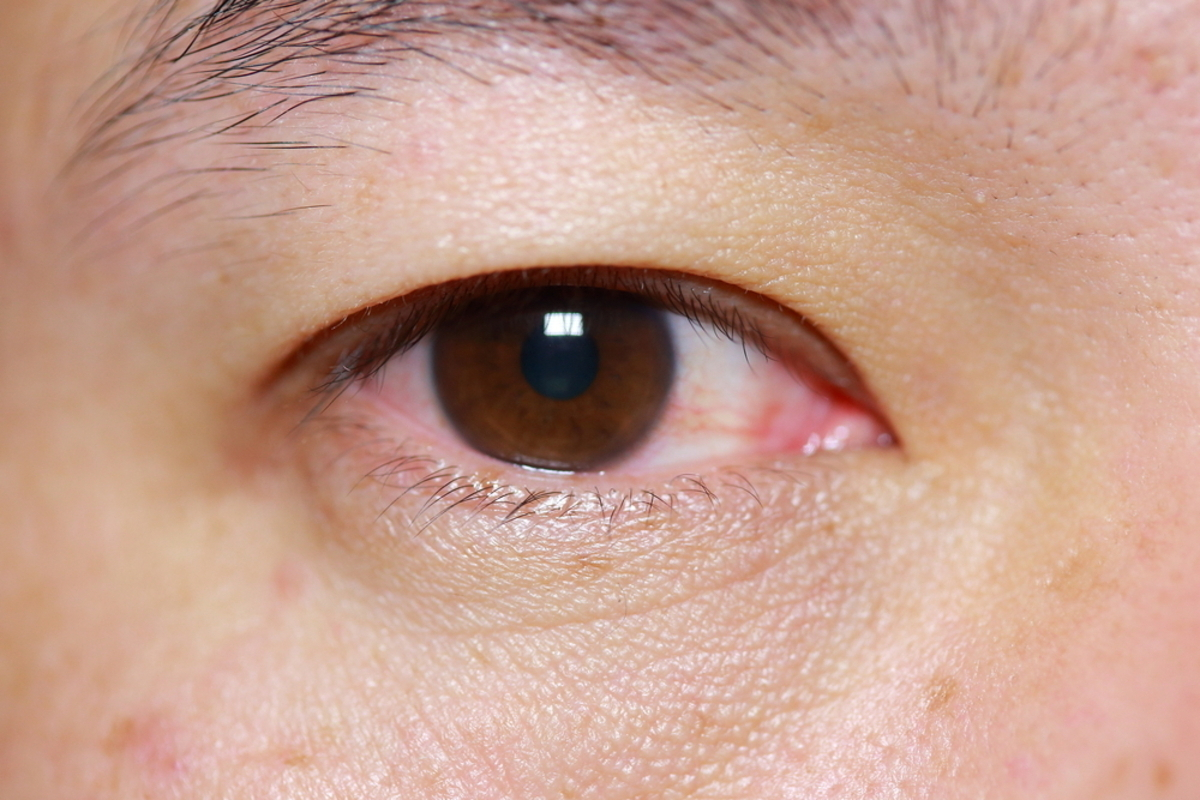Allergic Conjunctivitis in One Eye