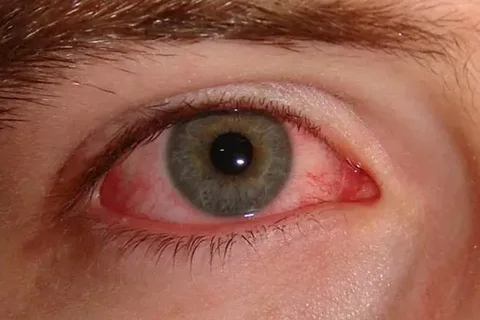 Allergic Conjunctivitis in One Eye